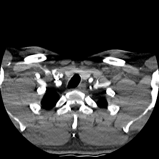 Buccal fat pad arteriovenous malformation (Radiopaedia 70936-81144 D 41).jpg