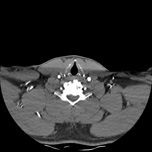 Buccal fat pad arteriovenous malformation (Radiopaedia 70936-81144 D 84).jpg