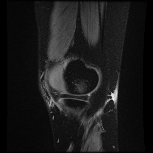 File:Bucket handle meniscus tear (Radiopaedia 56916-63751 H 73).jpg