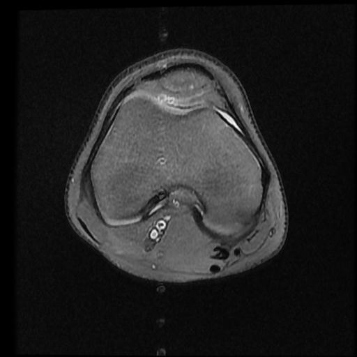 File:Bucket handle tear - lateral meniscus (Radiopaedia 72124-82634 Axial PD fat sat 6).jpg