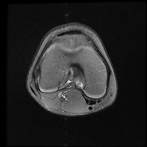 File:Bucket handle tear - lateral meniscus (Radiopaedia 72124-82634 Axial PD fat sat 8).jpg