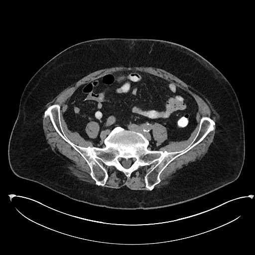 Buried bumper syndrome - gastrostomy tube (Radiopaedia 63843-72577 Axial Inject 89).jpg