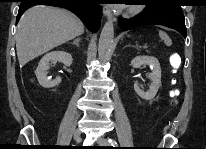 Buried bumper syndrome - gastrostomy tube (Radiopaedia 63843-72577 Coronal Inject 82).jpg