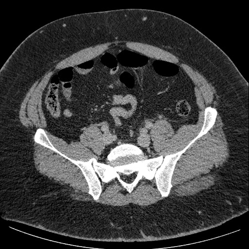 Burned-out testicular seminoma - retroperitoneal nodal metastases (Radiopaedia 62872-71245 A 54).jpg