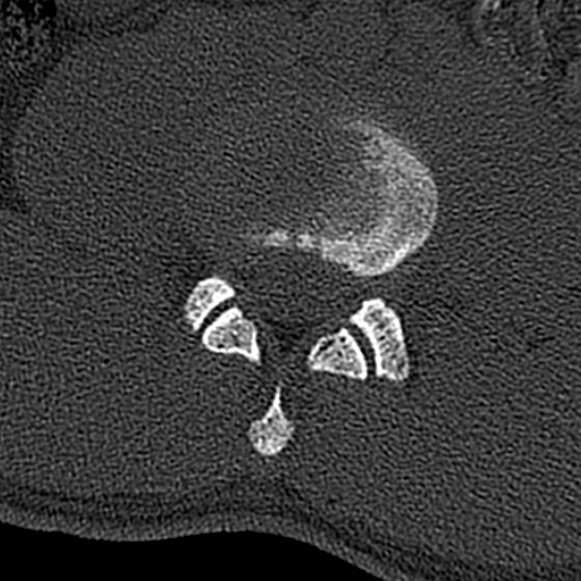 Burst fracture (Radiopaedia 53373-59357 Axial bone window 41).jpg