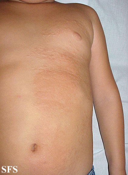 Buschke-Ollendorf Syndrome (Dermatology Atlas 2).jpg