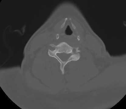 File:C7 laminar fracture and Klippel-Feil syndrome (Radiopaedia 86710-102850 Axial bone window 47).jpg