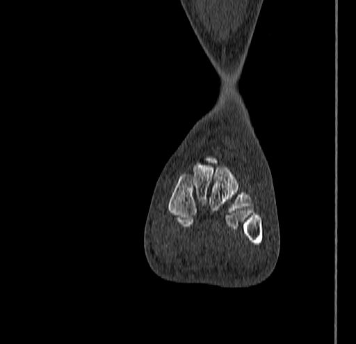 Calcaneal fracture - Sanders type 4 (Radiopaedia 90179-107370 Coronal bone window 46).jpg