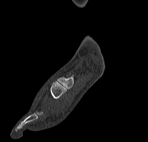 Calcaneal fracture - Sanders type 4 (Radiopaedia 90179-107370 Sagittal bone window 25).jpg