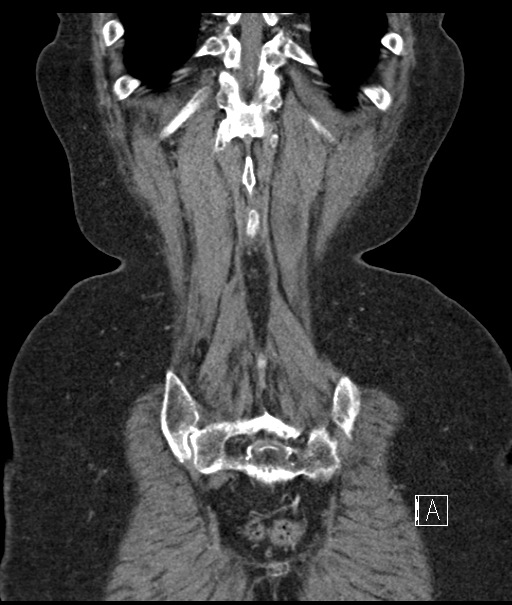 Calcified adrenal glands and Spigelian hernia (Radiopaedia 49741-54988 B 106).jpg