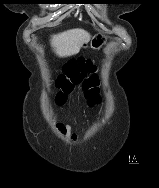 Calcified adrenal glands and Spigelian hernia (Radiopaedia 49741-54988 B 14).jpg