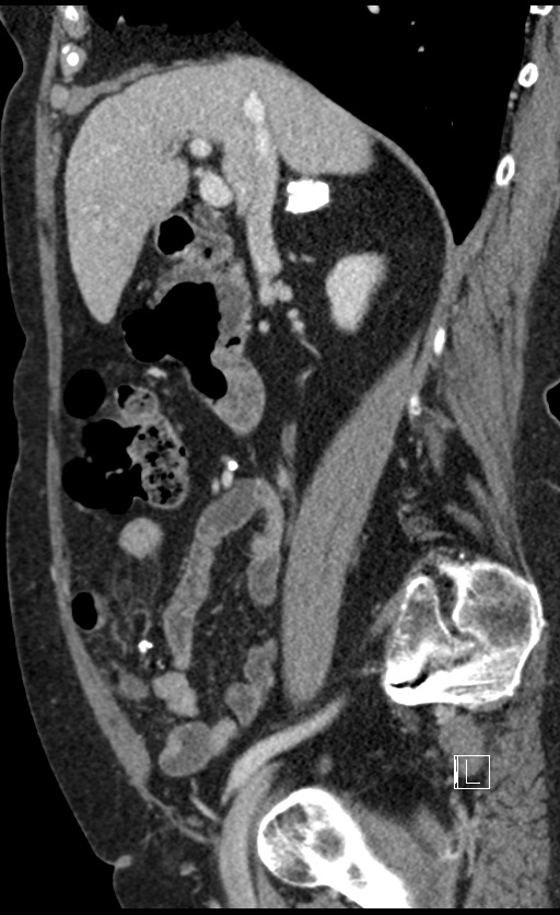 Calcified adrenal glands and Spigelian hernia (Radiopaedia 49741-54988 C 104).jpg