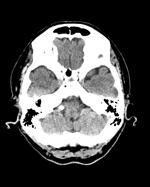 Calcified meningioma (Radiopaedia 74361-85243 Axial non-contrast 40).jpg