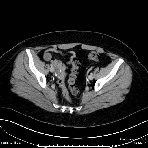 File:Calcified uterine fibroid (Radiopaedia 56077-62759 Axial C+ delayed 2).jpg