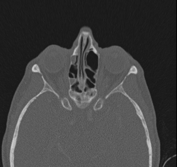 Caldwell-Luc operation (Radiopaedia 52329-58225 Axial bone window 22).jpg