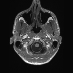 Callosal dysgenesis with interhemispheric cyst (Radiopaedia 53355-59335 Axial T1 11).jpg