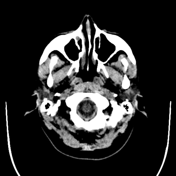 File:Calvarial osteoma (Radiopaedia 36520-38079 Axial non-contrast 5).jpg