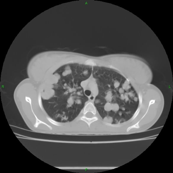 File:Cannon ball metastases - synovial sarcoma (Radiopaedia 26135-26271 Axial lung window 11).jpg