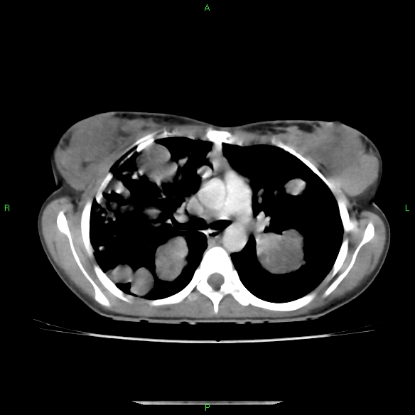 File:Cannon ball metastases - synovial sarcoma (Radiopaedia 26135-26271 C 15).jpg