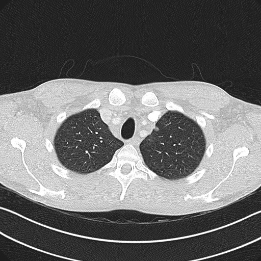 File:Cannonball metastases - testicular choriocarcinoma (Radiopaedia 84510-99891 Axial lung window 21).jpg