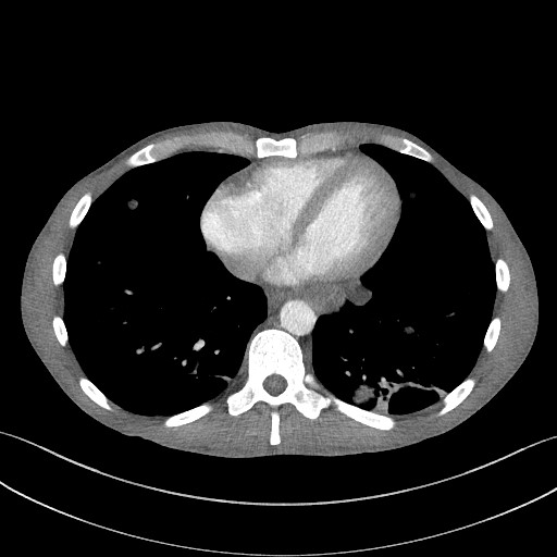 Cannonball metastases - testicular choriocarcinoma (Radiopaedia 84510-99891 B 79).jpg