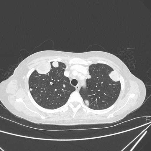 Canonball lung metastasis (Radiopaedia 77634-89837 Axial lung window 44).jpg