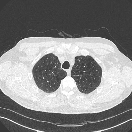 Caplan syndrome (Radiopaedia 56667-63530 Axial lung window 44).jpg