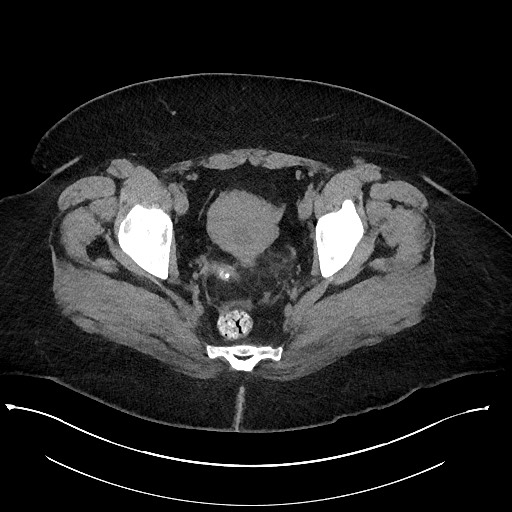 Carcinoid tumor - terminal ileum (Radiopaedia 60931-68740 Axial non-contrast 111).jpg