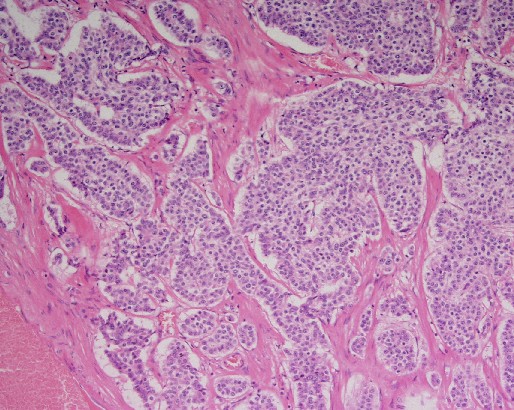 File:Carcinoid tumor of the ileum with metastasis to orbit (Radiopaedia 28165-28427 B 1).jpg