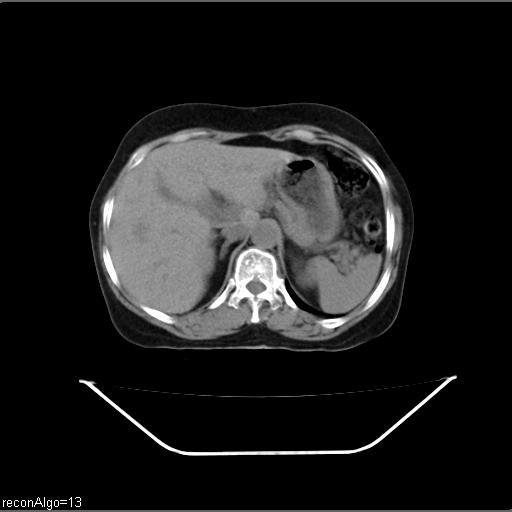 File:Carcinoma cervix- recurrence (Radiopaedia 34702-36137 Axial non-contrast 12).jpg