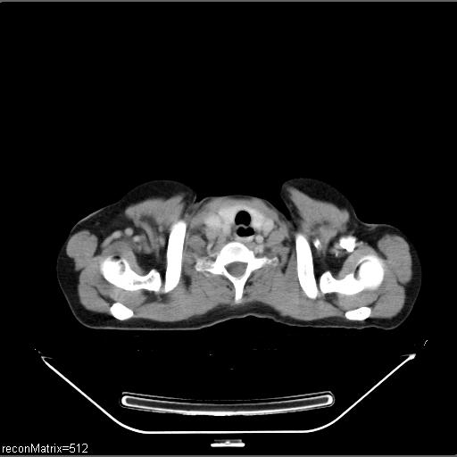 File:Carcinoma of esophagus (Radiopaedia 27356-27550 A 32).jpg