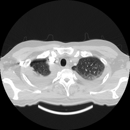Cardiac tamponade (Radiopaedia 78607-91368 Axial lung window 6).jpg