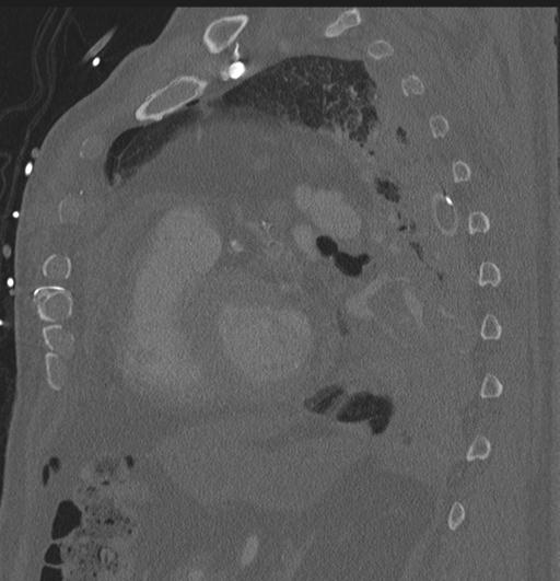 Cardiac trauma (Radiopaedia 32874-33858 Sagittal bone window 10).jpg