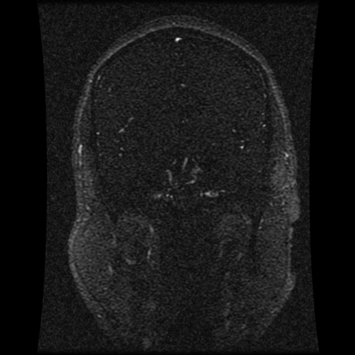 Carotid arterial dissection with acute cerebral infarction (Radiopaedia 26636-26784 MRV 103).jpg