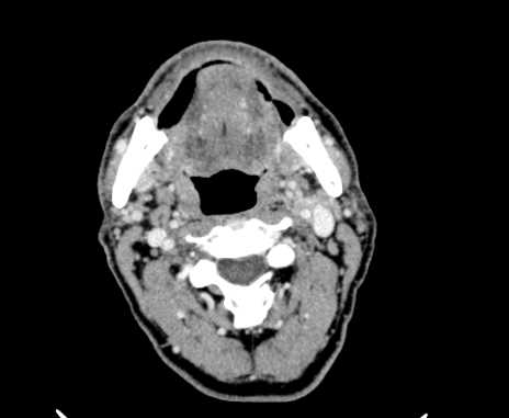 Carotid body tumor (Radiopaedia 61750-69757 Axial Post contrast 35).jpg
