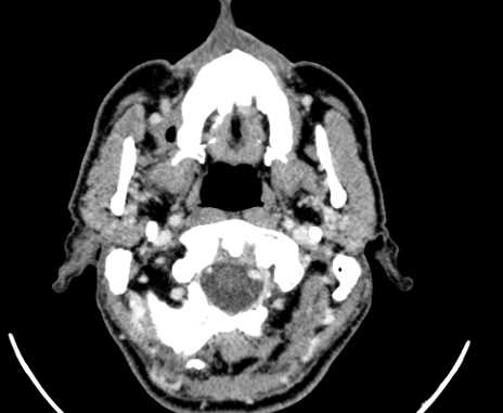 File:Carotid body tumor (Radiopaedia 61750-69757 Axial Post contrast 6).jpg