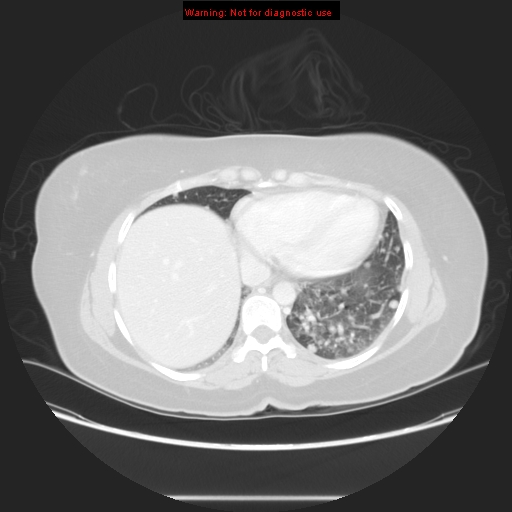 Carotid body tumor with lung metastases (Radiopaedia 9301-48390 Axial lung window 52).jpg