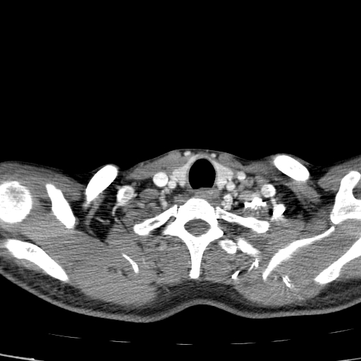 File:Carotid bulb pseudoaneurysm (Radiopaedia 57670-64616 A 63).jpg
