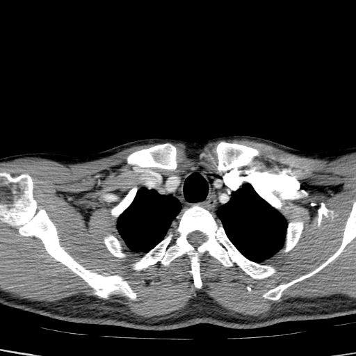 File:Carotid bulb pseudoaneurysm (Radiopaedia 57670-64616 A 74).jpg