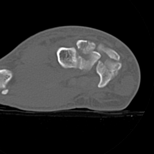 File:Carpo-metacarpal fracture-dislocations with hamatum split fracture (Radiopaedia 18482-18343 Axial bone window 15).jpg