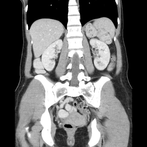 Castleman disease with fibrous pseudotumor in the abdomen (Radiopaedia 77296-89373 B 64).jpg