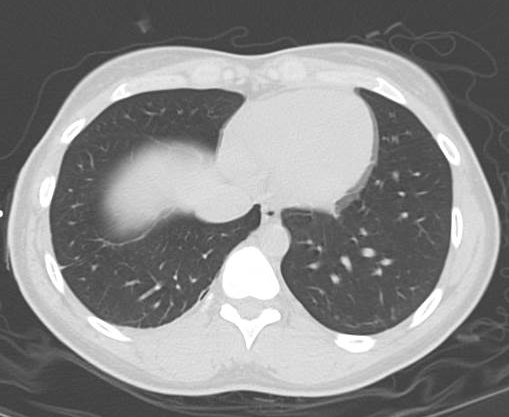 File:Catamenial pneumothorax (Radiopaedia 54382-60600 Axial 56).png