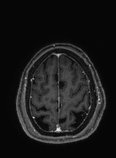 Cavernous hemangioma of the cerebellar falx (Radiopaedia 73025-83724 Axial T1 C+ 62).jpg