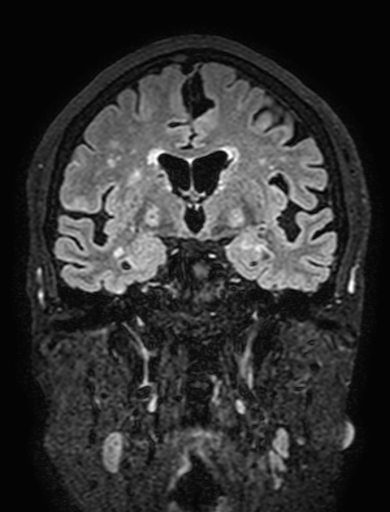 Cavernous hemangioma of the cerebellar falx (Radiopaedia 73025-83724 Coronal FLAIR 161).jpg