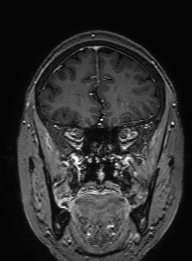 Cavernous hemangioma of the cerebellar falx (Radiopaedia 73025-83724 Coronal T1 C+ 104).jpg