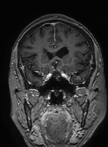 Cavernous hemangioma of the cerebellar falx (Radiopaedia 73025-83724 Coronal T1 C+ 129).jpg