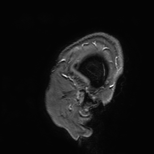 Cavernous hemangioma of the cerebellar falx (Radiopaedia 73025-83724 Sagittal T1 C+ 7).jpg