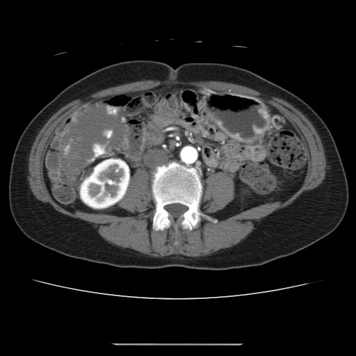 Cavernous hepatic hemangioma (Radiopaedia 75441-86667 A 62).jpg
