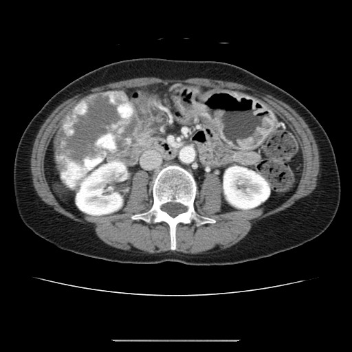 File:Cavernous hepatic hemangioma (Radiopaedia 75441-86667 B 55).jpg