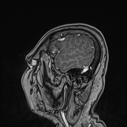 Cavernous sinus meningioma (Radiopaedia 63682-72367 Sagittal T1 C+ 39).jpg